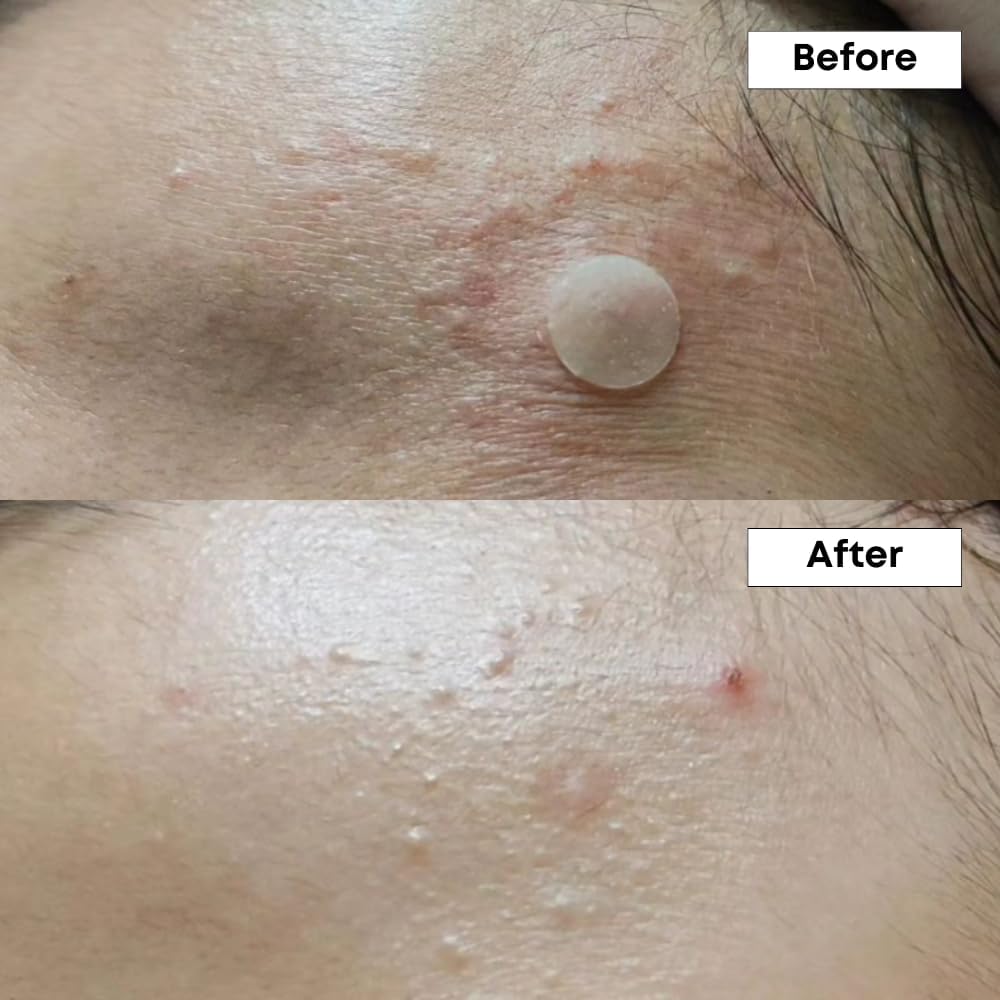 NINE LESS/ A-Control 10% Azelaic Acid Serum 30ml: ناين ليس سيروم الازليك اسيد