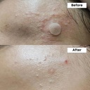 NINE LESS/ A-Control 10% Azelaic Acid Serum 30ml: ناين ليس سيروم الازليك اسيد